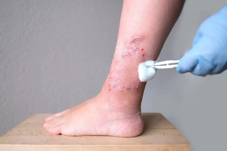 5 Surprising Causes of Slow Wound Healing and What They Mean