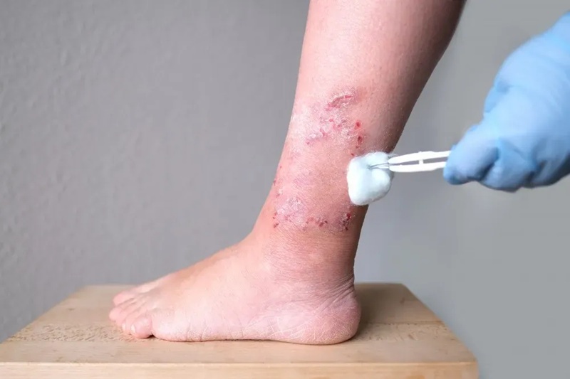5 Surprising Causes of Slow Wound Healing and What They Mean