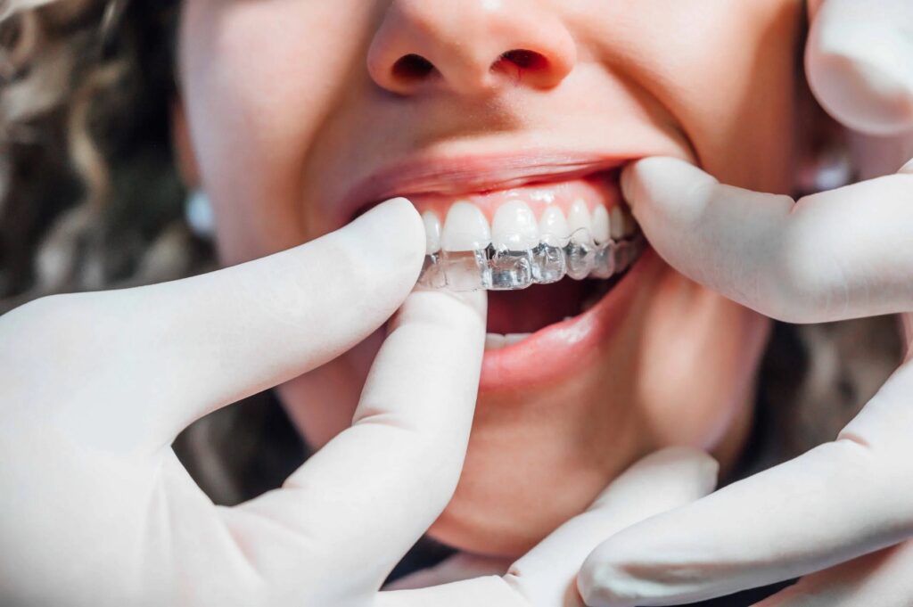 How Invisalign Transforms Teen Smiles: Key Benefits Explained