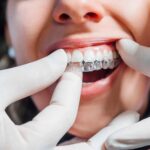 How Invisalign Transforms Teen Smiles: Key Benefits Explained